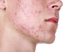 Living With Acne